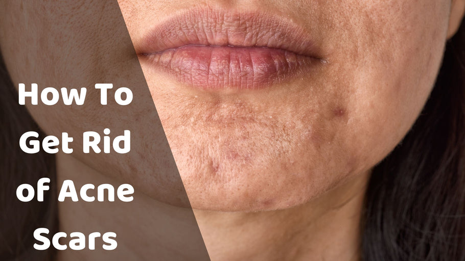 How To Get Rid of Acne Scars