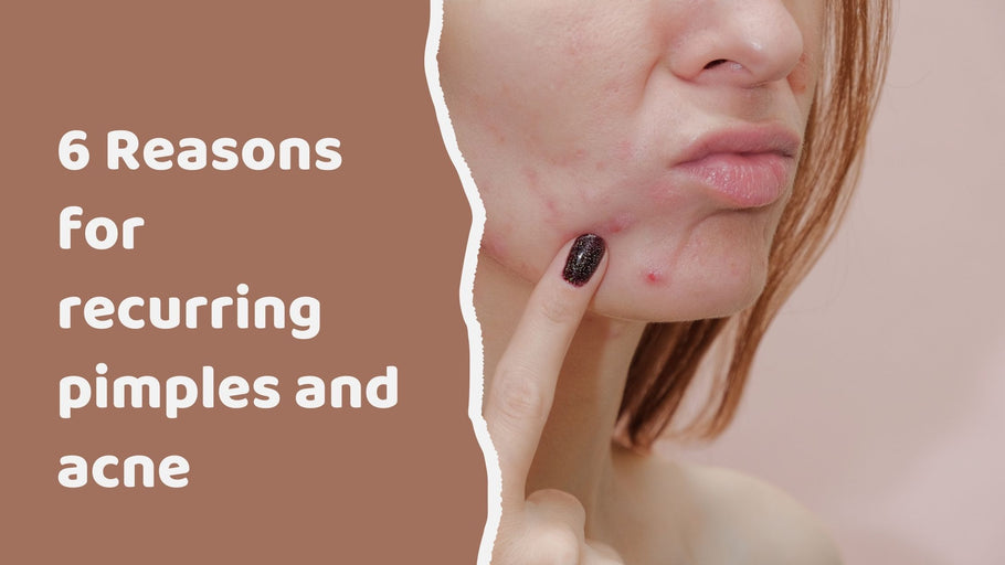 6 Reasons for recurring pimples and acne