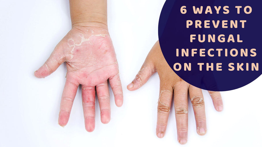 6 Ways To Prevent Fungal Infections On The Skin